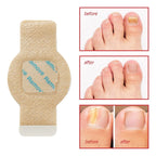 Parches Para Hongos En Uñas TTT