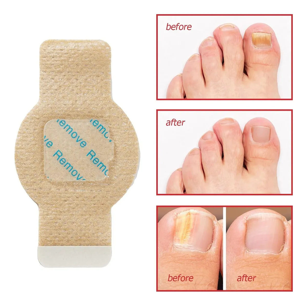Parches Para Hongos En Uñas TTT